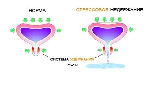 Недержание мочи у женщин